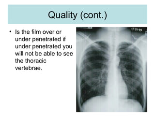 Quality (cont.)
• Is the film over or
under penetrated if
under penetrated you
will not be able to see
the thoracic
vertebrae.
 