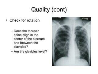 Quality (cont)
• Check for rotation
– Does the thoracic
spine align in the
center of the sternum
and between the
clavicles?
– Are the clavicles level?
 