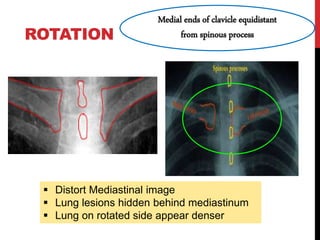 ROTATION
Medial ends of clavicle equidistant
from spinous process
 Distort Mediastinal image
 Lung lesions hidden behind mediastinum
 Lung on rotated side appear denser
 