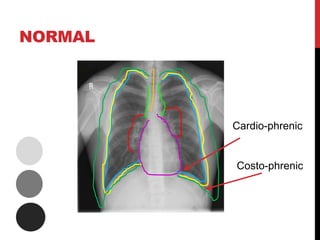 NORMAL
Cardio-phrenic
Costo-phrenic
 