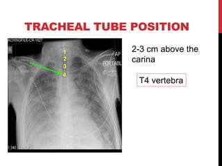 TRACHEAL TUBE POSITION
2-3 cm above the
carina
T4 vertebra
1
3
2
4
 