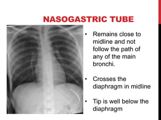 NASOGASTRIC TUBE
• Remains close to
midline and not
follow the path of
any of the main
bronchi.
• Crosses the
diaphragm in midline
• Tip is well below the
diaphragm
 