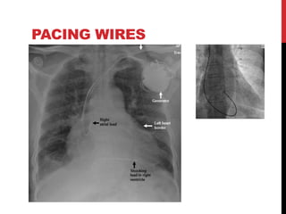 PACING WIRES
 