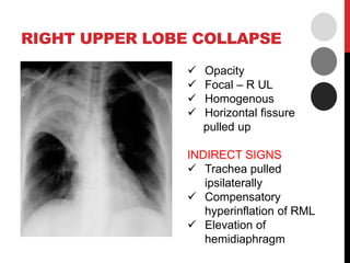 RIGHT UPPER LOBE COLLAPSE
 Opacity
 Focal – R UL
 Homogenous
 Horizontal fissure
pulled up
INDIRECT SIGNS
 Trachea pulled
ipsilaterally
 Compensatory
hyperinflation of RML
 Elevation of
hemidiaphragm
 