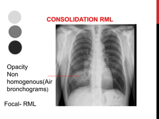 CONSOLIDATION RML
Opacity
Non
homogenous(Air
bronchograms)
Focal- RML
 