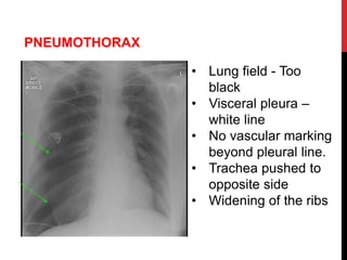 PNEUMOTHORAX
• Lung field - Too
black
• Visceral pleura –
white line
• No vascular marking
beyond pleural line.
• Trachea pushed to
opposite side
• Widening of the ribs
 