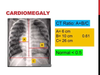 CARDIOMEGALY
A
B
C
A= 6 cm
B= 10 cm 0.61
C= 26 cm
CT Ratio: A+B/C
Normal < 0.5
 