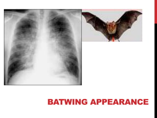 BATWING APPEARANCE
 