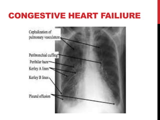 CONGESTIVE HEART FAILIURE
 