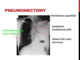 PNEUMONECTOMY
Hemithorax opacified
Ipsilateral
mediastinal shiftContralateral lung
hyper-inflated
Absent left main
bronchus
 