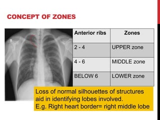 CONCEPT OF ZONES
Anterior ribs Zones
2 - 4 UPPER zone
4 - 6 MIDDLE zone
BELOW 6 LOWER zone
Loss of normal silhouettes of structures
aid in identifying lobes involved.
E.g. Right heart border= right middle lobe
 