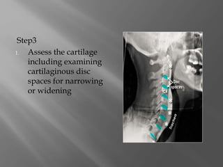 Step3
1. Assess the cartilage
including examining
cartilaginous disc
spaces for narrowing
or widening
 