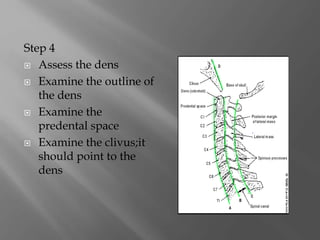 Step 4
 Assess the dens
 Examine the outline of
the dens
 Examine the
predental space
 Examine the clivus;it
should point to the
dens
 