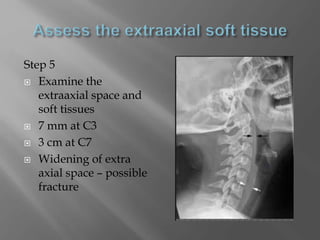 Step 5
 Examine the
extraaxial space and
soft tissues
 7 mm at C3
 3 cm at C7
 Widening of extra
axial space – possible
fracture
 