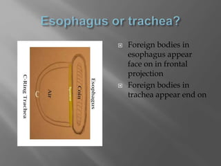  Foreign bodies in
esophagus appear
face on in frontal
projection
 Foreign bodies in
trachea appear end on
 