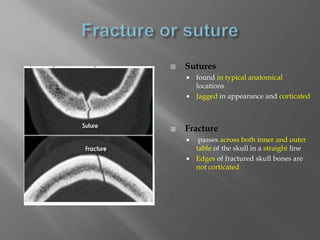  Sutures
 found in typical anatomical
locations
 Jagged in appearance and corticated
 Fracture
 passes across both inner and outer
table of the skull in a straight line
 Edges of fractured skull bones are
not corticated
 