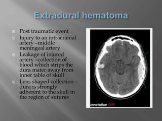  Post traumatic event
 Injury to an intracranial
artery –middle
meningeal artery
 Leakage of injured
artery –collection of
blood which strips the
dura mater away from
inner table of skull
 Lens shaped collection –
dura is strongly
adherent to the skull in
the region of sutures
 