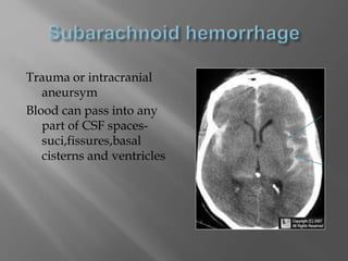 Trauma or intracranial
aneursym
Blood can pass into any
part of CSF spaces-
suci,fissures,basal
cisterns and ventricles
 