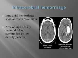  Intra axial hemorrhage -
spontaneous or traumatic
 Area of high density
material (blood)
surrounded by low
density(oedema)
 