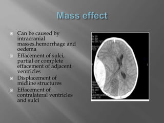  Can be caused by
intracranial
masses,hemorrhage and
oedema
 Effacement of sulci,
partial or complete
effacement of adjacent
ventricles
 Displacement of
midline structures
 Effacement of
contralateral ventricles
and sulci
 