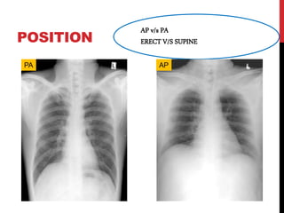 POSITION
AP v/s PA
ERECT V/S SUPINE
PA AP
 