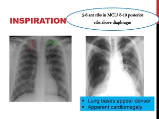INSPIRATION
5-6 ant ribs in MCL/ 8-10 posterior
ribs above diaphragm
 Lung bases appear denser
 Apparent cardiomegaly
 