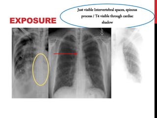 EXPOSURE
Just visible Intervertebral spaces, spinous
process / T4 visible through cardiac
shadow
 