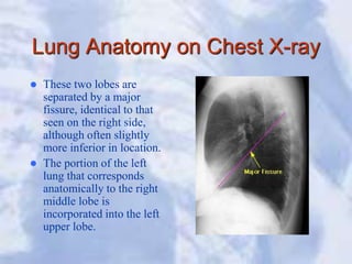 Lung Anatomy on Chest X-ray
 These two lobes are
separated by a major
fissure, identical to that
seen on the right side,
although often slightly
more inferior in location.
 The portion of the left
lung that corresponds
anatomically to the right
middle lobe is
incorporated into the left
upper lobe.
 
