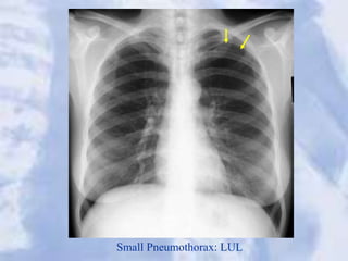 Small Pneumothorax: LUL
 