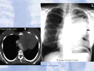 Primary b cell lymphoma
 