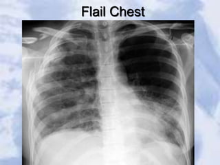 Flail Chest
 