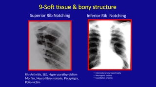 Superior Rib Notching Chest xray - overview on mechanism of xray.pptx