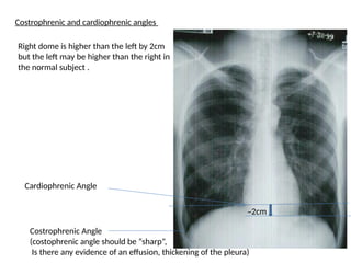 Chest X-ray in various respiratory conditions | PPTX