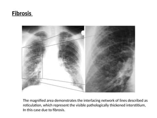 Typical Reticulation Line Chest X-ray in various respiratory conditions | PPTX