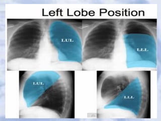 Chest x-ray booklet for medical school.pdf