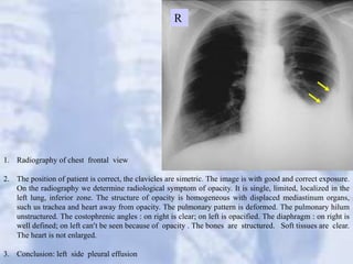 Chest x-ray booklet for medical school.pdf