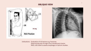 Comprehensive Guide to Chest X-Ray Techniques, Positioning, and ...