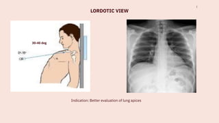 Comprehensive Guide to Chest X-Ray Techniques, Positioning, and ...