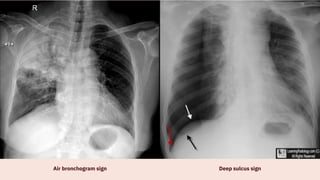 Comprehensive Guide to Chest X-Ray Techniques, Positioning, and ...