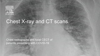 Chest X-ray and CT scans
Chest radiographs and Axial CECT of
patients presenting with COVID-19
 