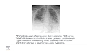 Heterogeneous Opacity Chest X-Ray and CT Images of Novel Coronavirus | PPTX