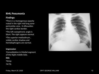 Comprehensive Chest X-Ray Pattern Recognition in Pulmonary Diseases | PPT