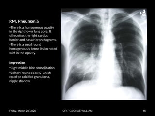 Comprehensive Chest X-Ray Pattern Recognition in Pulmonary Diseases | PPT
