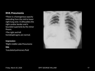 Comprehensive Chest X-Ray Pattern Recognition in Pulmonary Diseases | PPT