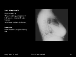 Rml Collapse Radiograph Comprehensive Chest X-Ray Pattern Recognition in Pulmonary Diseases | PPT