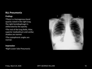 Comprehensive Chest X-Ray Pattern Recognition in Pulmonary Diseases | PPT