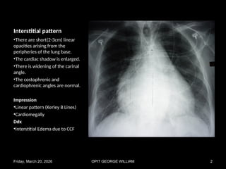Lung Radiograph Patterns Comprehensive Chest X-Ray Pattern Recognition in Pulmonary Diseases | PPT