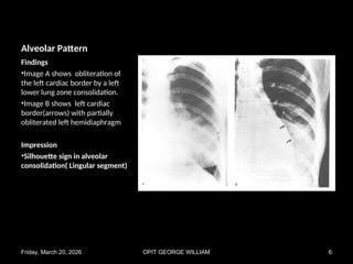 Comprehensive Chest X-Ray Pattern Recognition in Pulmonary Diseases | PPT
