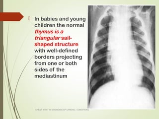 Triangular Sign Chest Cxr congenital | PPT