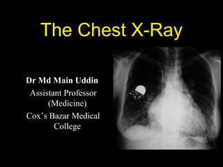 The Chest X-Ray
Dr Md Main Uddin
Assistant Professor
(Medicine)
Cox’s Bazar Medical
College
 